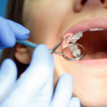 What is the Average Cost of Invisalign Treatment at a Dentist in Fairhope, Alabama?
