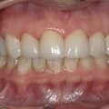 Do Dentists in Fairhope, AL Offer Teeth Whitening Services?