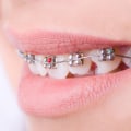 What is the Cost of Braces at a Dentist in Fairhope, Alabama?