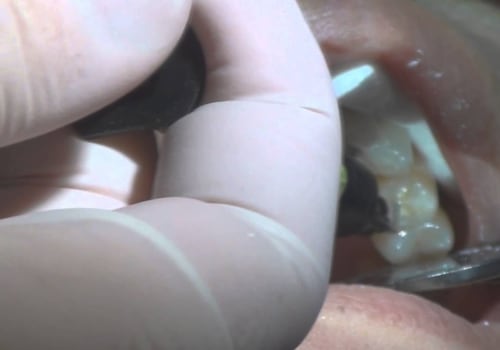Do Dentists in Fairhope, Alabama Offer Dental Implant Services?
