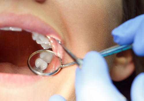 What is the Average Cost of Invisalign Treatment at a Dentist in Fairhope, Alabama?