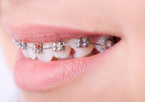 What is the Cost of Braces at a Dentist in Fairhope, Alabama?